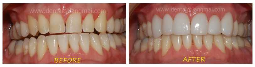Dental Veneers by Dental Chiang Mai patient 4
