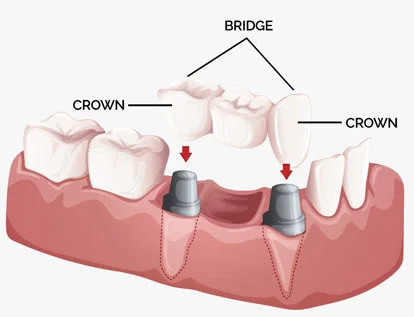 สะพานฟัน Dental Bridge Chiang Mai, Thailand