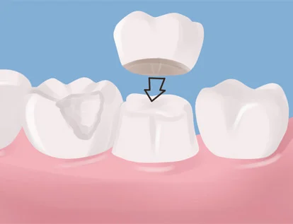 ครอบฟัน Dental Crown