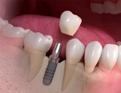 รากฟันเทียม Dental Implant