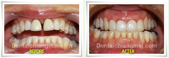 ตัวอย่างการทำวีเนียร์ หรือการเคลือบฟันเทียม Dental Veneers by Dental Chiang Mai patient 1