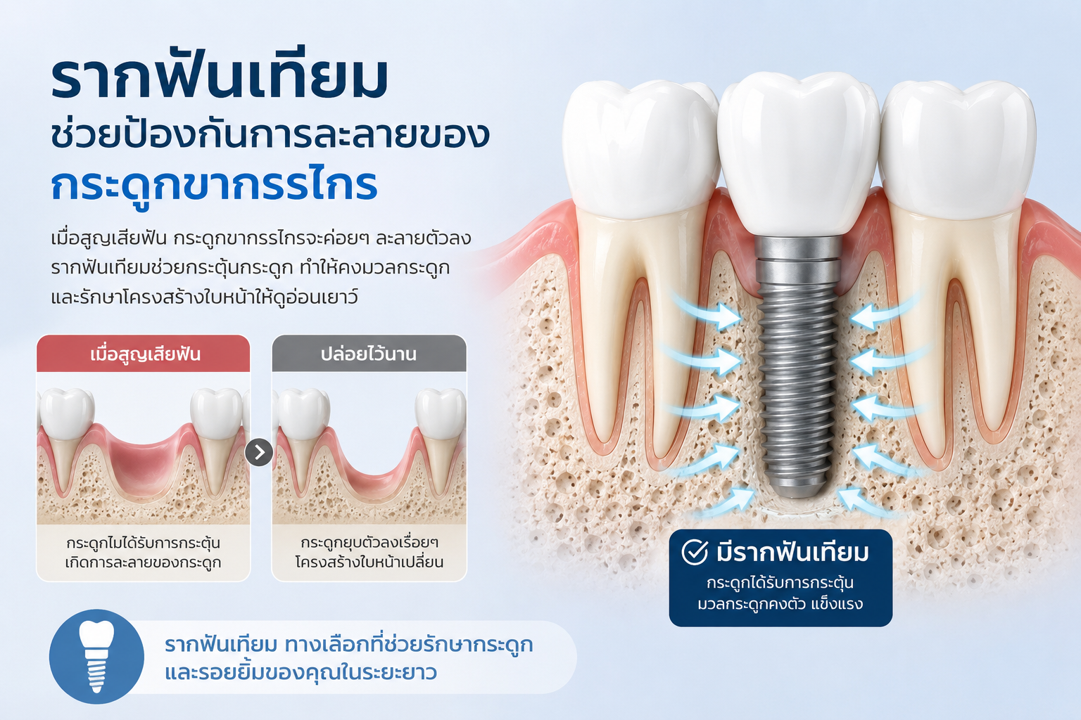 10 ข้อดีของการใส่รากฟันเทียม