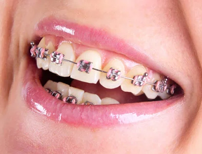 จัดฟันเ เชียงใหม่ Orthodontics Treatment