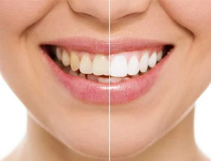 การฟอกสีฟัน Teeth Whitening Dental Chiang Mai, Thailand