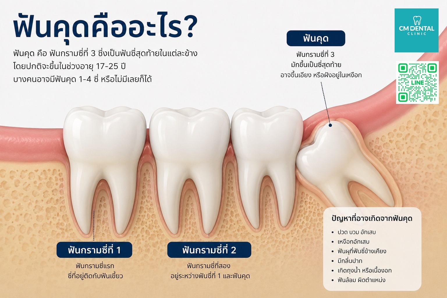 ผ่าฟันคุดเชียงใหม่
