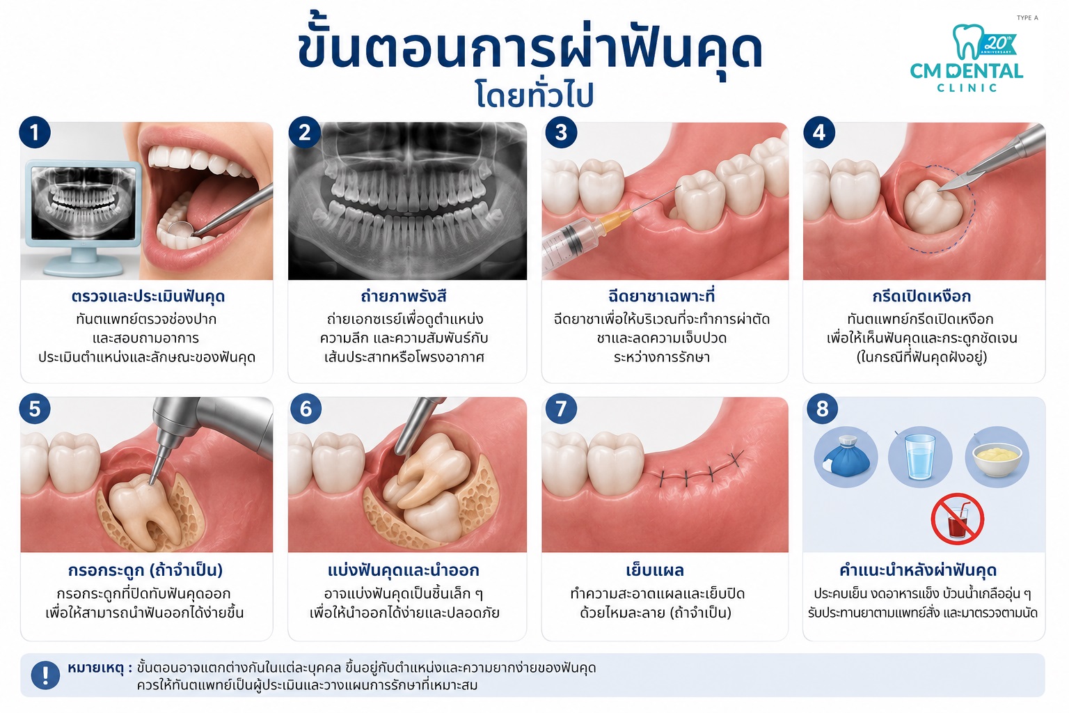 ถอนฟันคุดเชียงใหม่